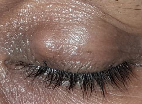 Masas ocular